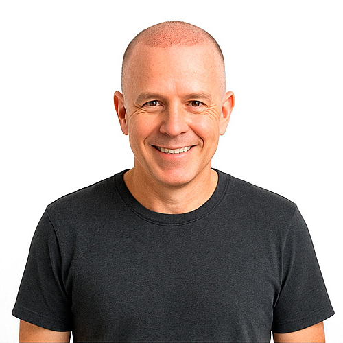 Día 1 - preoperatorio Injerto capilar en Las Palmas