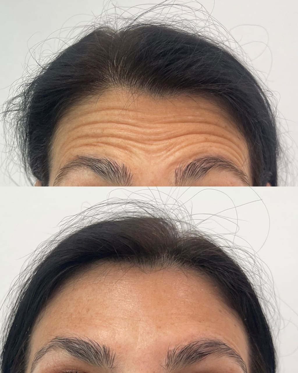 Resultado toxina botulínica - DC Clinic