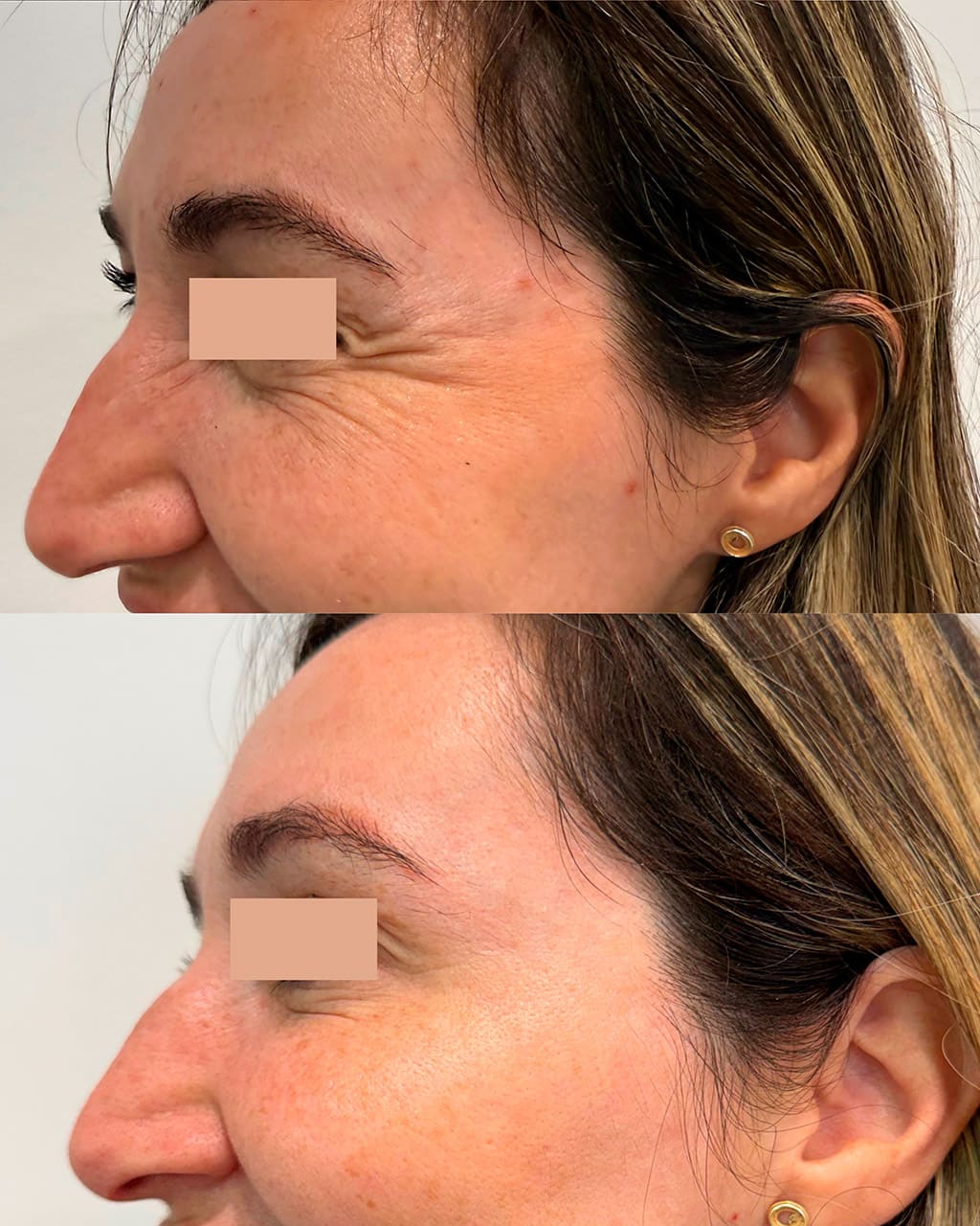 Resultado toxina botulínica - DC Clinic