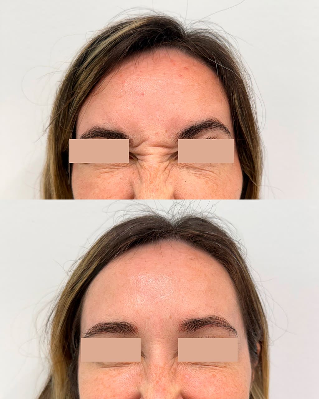 Resultado toxina botulínica - DC Clinic