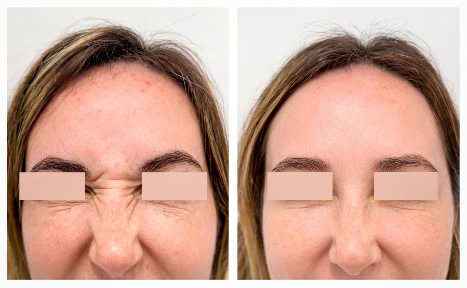 Tratamiento de toxina botulínica en Las Palmas - DC Clinic